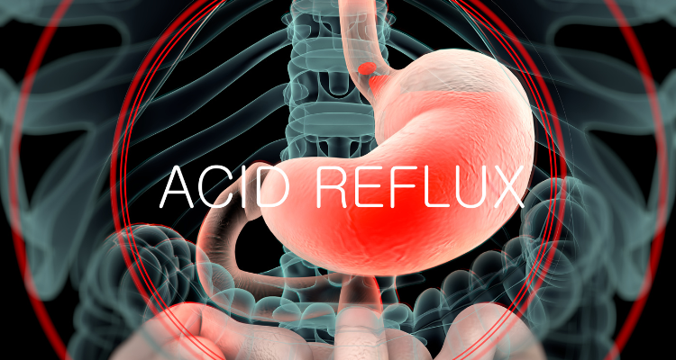 acid reflux